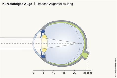 Kurzsichtigkeit München Behandlung Augenarzt Privatpraxis Dr Zarth
