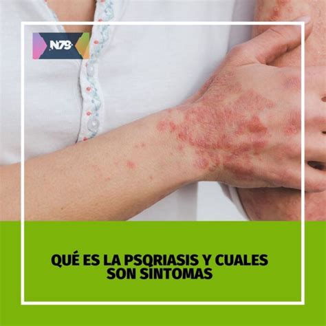 Qu Es La Psoriasis Y Cuales Son S Ntomas