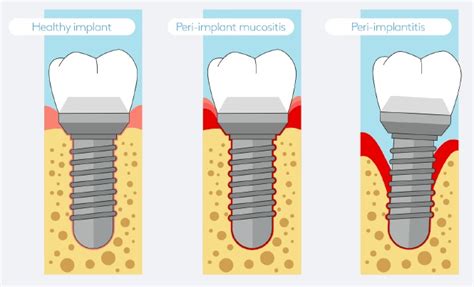 Peri Implant Mucositis And Peri Implantitis Gum Disease Around Dental