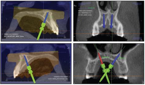 Tandem Skeletal Expander And Mapa Protocol For Palatal Expansion In