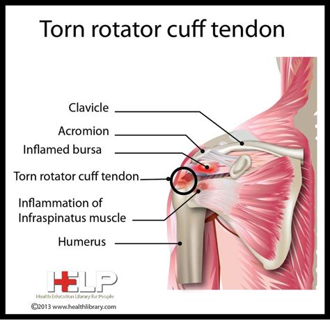 Torn Rotator Cuff Tendon