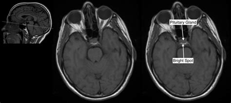 Pituitary Gland Mri Anatomy