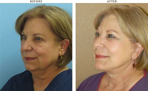 Mid Face Lift – Before and After Pictures * – Dr Turowski – Plastic Surgery Chicago