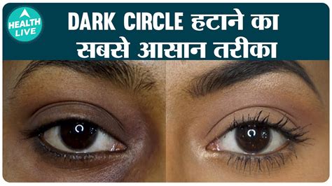 Dark Circles Causes And Treatment Home Remedy For Removing Dark Circles Health Live Youtube