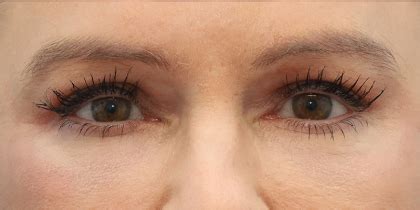 Patient Lower Blepharoplasty Before And After Photos Phoenix