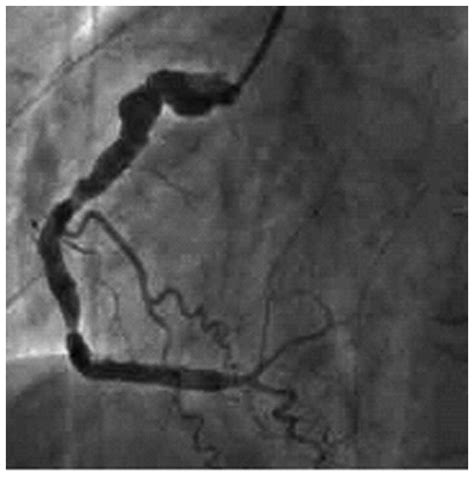 A Comparison Study Between Ct Angiography With 64 Multislice Spiral