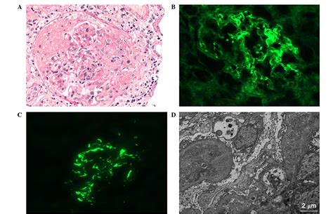 Novel Therapy For Anti Glomerular Basement Membrane Disease With IgA