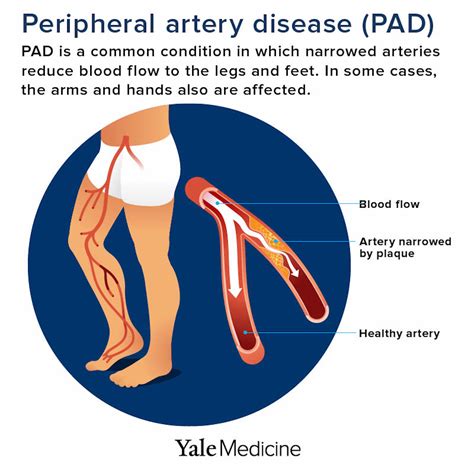 Peripheral Artery Disease Is Poorly Understood—and Yale Researchers Are