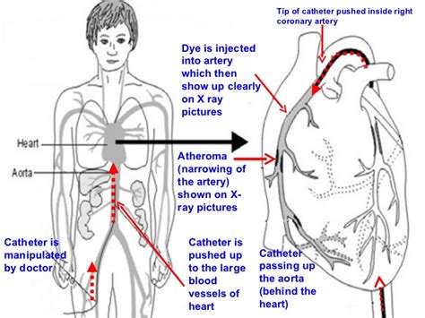 Coronary Angiography Procedure