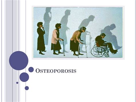 PPT - Osteoporosis PowerPoint Presentation, free download - ID:9507623