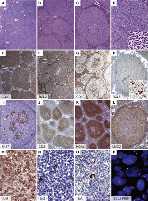 Morphologic And Immunophenotypic Findings In The Inguinal Lymph Node