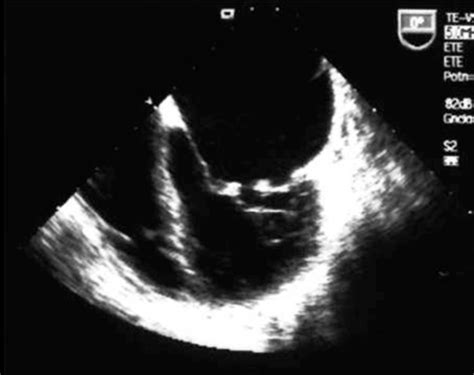 Regurgitación mitral severa en endocarditis de Libman Sacks Cirugía