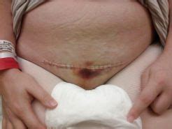 Horny Wifes With C Section Scars Porn Pictures XXX Photos Sex Images 1764854 PICTOA