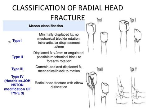 Radial Head Fracture And physical therapy