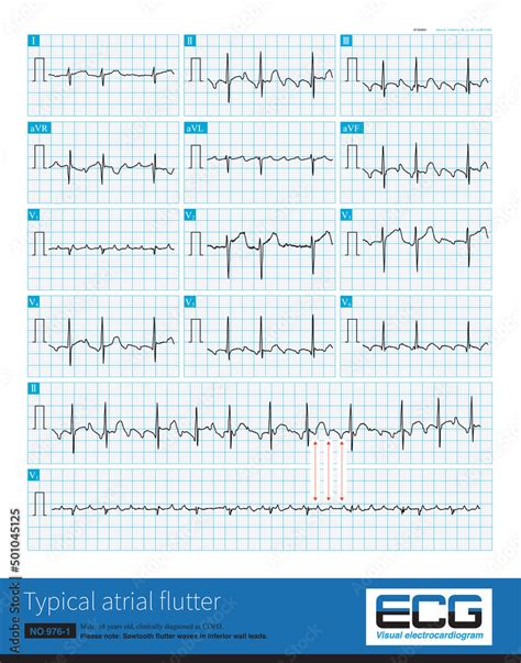 Male Years Old Clinically Diagnosed As Copd Paroxysmal Atrial