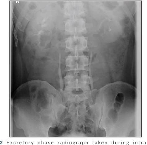 Figure 2 From Minimal Fat Renal Angiomyolipoma With Central Scar And