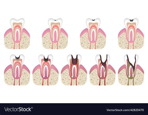 Stages of caries development tooth structure Vector Image