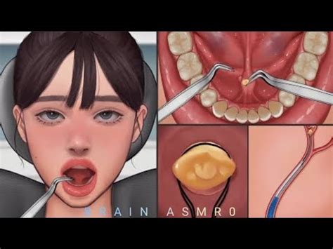 Asmr Salivary Gland Stones Removalanimation Brainasmr Youtube