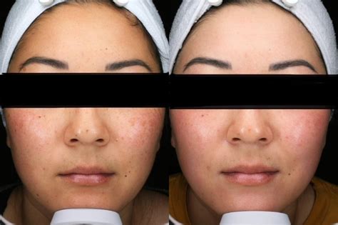 Moxi Laser Skin Rejuvenation For Anchorage Wasilla Faces Med Spa