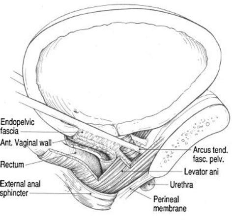 Figure 3 From Clinical Evaluation Of Transvaginal Mesh For Pelvic Organ Prolapse Surgery