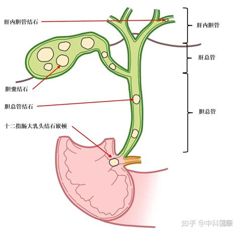 胆总管结石怎么回事？如何治疗更好呢？ 知乎