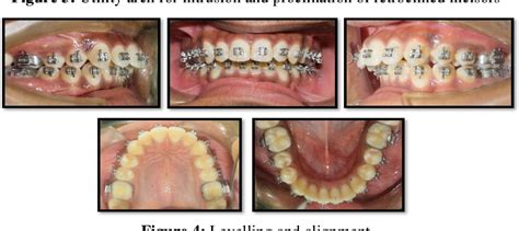 Figure 4 From Class Ii Correction With Forsus Fixed Functional Appliance In Class Ii Division 2