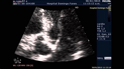 Estenosis Aortica Moderada Dr Pedro Guillermo Bustos 2 Febrero 2015