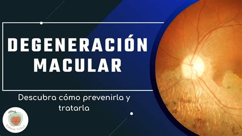 Degeneraci N Macular Qu Es Y Tratamientos Youtube