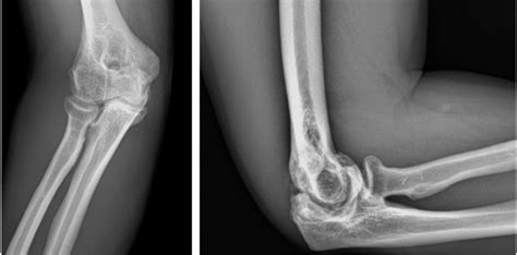 Preoperative Radiographs Including A Anteroposterior And B Lateral