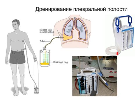 Дренирование плевральной полости, Москва: стоимость от 11000 рублей ...