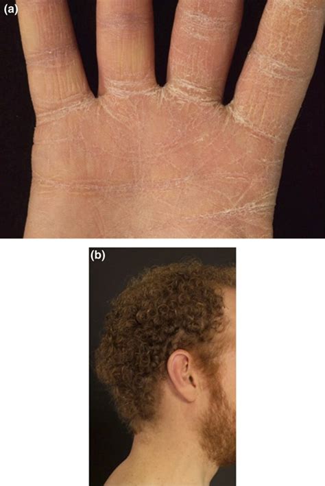 Inherited Palmoplantar Keratodermas The Heart Of The Matter Clinical