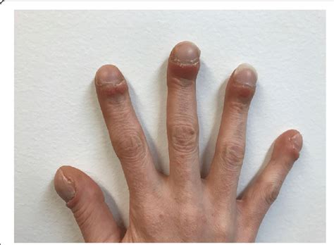 Clubbed Fingers And Nails Causes And What They Look Like Atelier