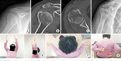 Figure 1 from Conservative Treatment of Proximal Humeral Fracture ...