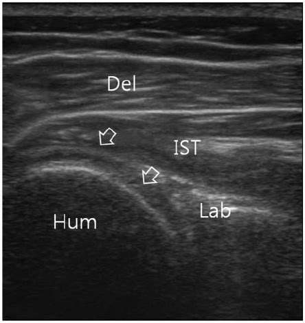 Ultrasound Guided Intra Articular Injection Under Real Time Ultrasound