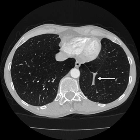 Luftsichel Sign And Juxtaphrenic Peak Sign Bmj Case Reports