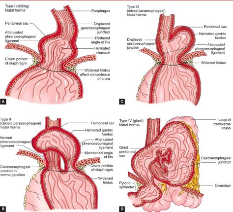 Figure 2 From Of Literatures On Laparoscopic Prosthetic Repair Of Giant