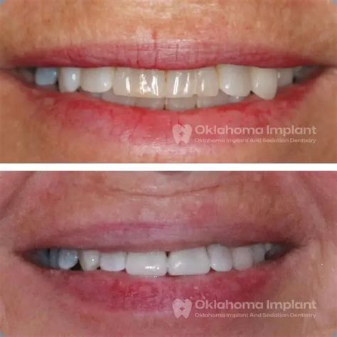 Get Dental Implants In Oklahoma City OK Oklahoma Implant Clinic