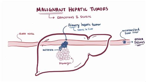 Hepatocellular carcinoma: Video, Anatomy & Definition | Osmosis