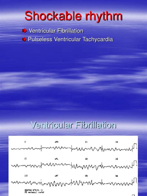 shockable   shockable rhythms