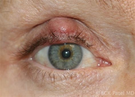 Meibomian Gland Cyst