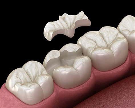 Porcelain Inlaysonlays Cera Tech Dental Lab