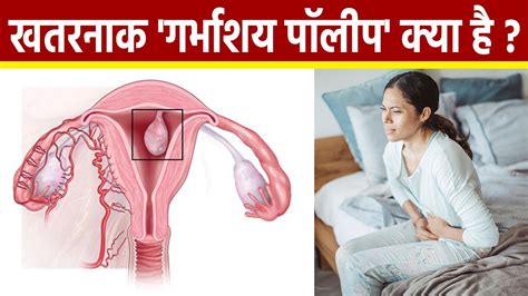 गर्भाशय पॉलीप क्या है Symptoms नजरअंदाज करना खतरनाक Uterine Polyp