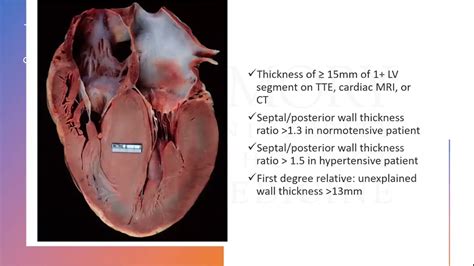 Hypertrophic Cardiomyopathy And Pregnancy Youtube