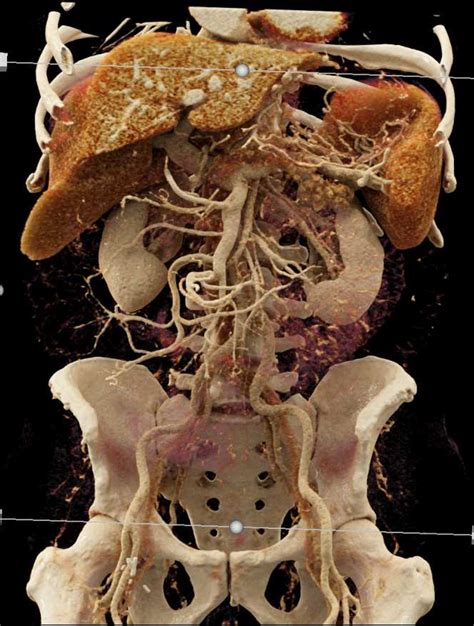 Pancreatic Cancer With Dilated Pancreatic Duct And Incidental Gist