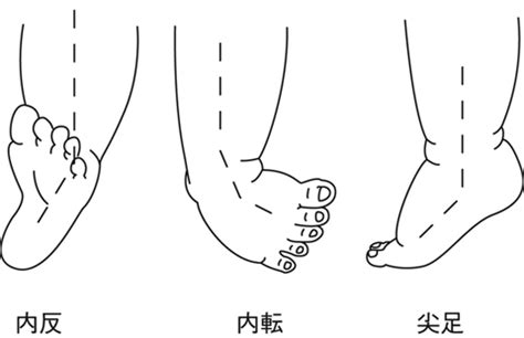 先天性内反足(せんてんせいないはんそく)とは？ 意味や使い方 - コトバンク