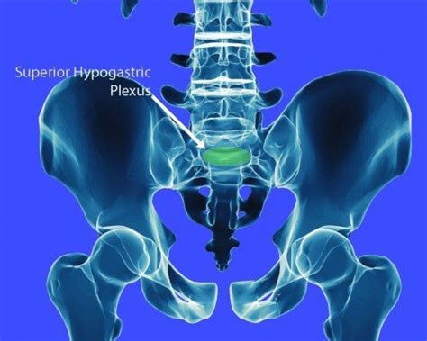 Superior Hypogastric Plexus Block - Ainsworth Institute