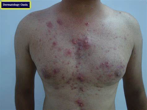 Inflammatory Acne Dermatology Oasis