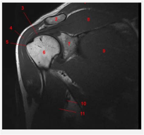 Shoulder Coronal View Diagram Quizlet