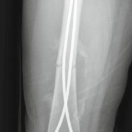 2 90-90 traction is considered for 14-21 days in length unstable ...