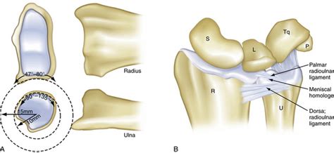 Injuries To The Triangular Fibrocartilage Complex Musculoskeletal Key